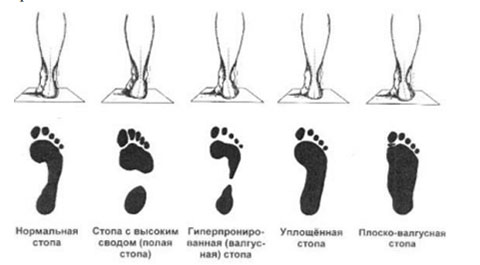 Что такое плоскостопие и плоско-вальгусная деформация стопы